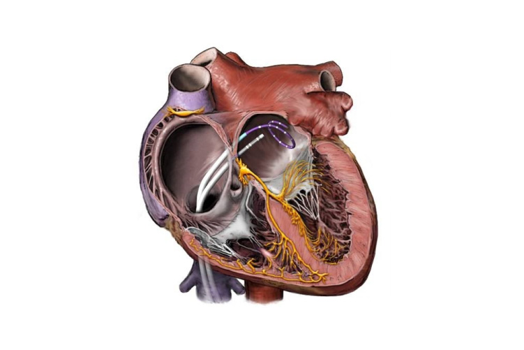 Ablación con catéter en pacientes con fibrilación auricular