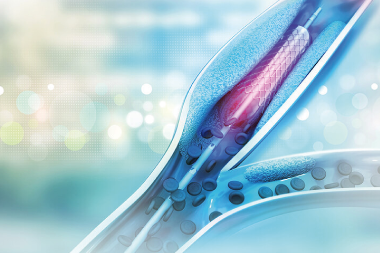 Ateneo de Cardiología - Puesta al día - Stens Bioabsorbibles