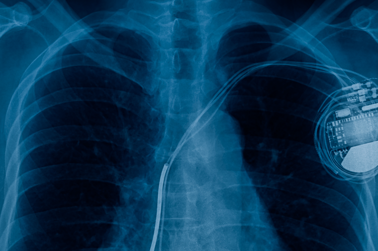 Preexcitación ventricular asintomática: ¿Una entidad benigna? A propósito de un caso.