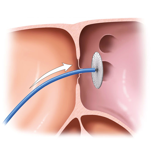 Ateneo Central Online | Cierre de Foramen Oval Permeable